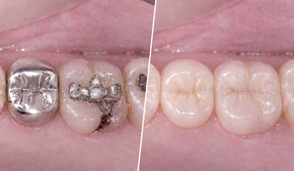 なるべく削らない治療