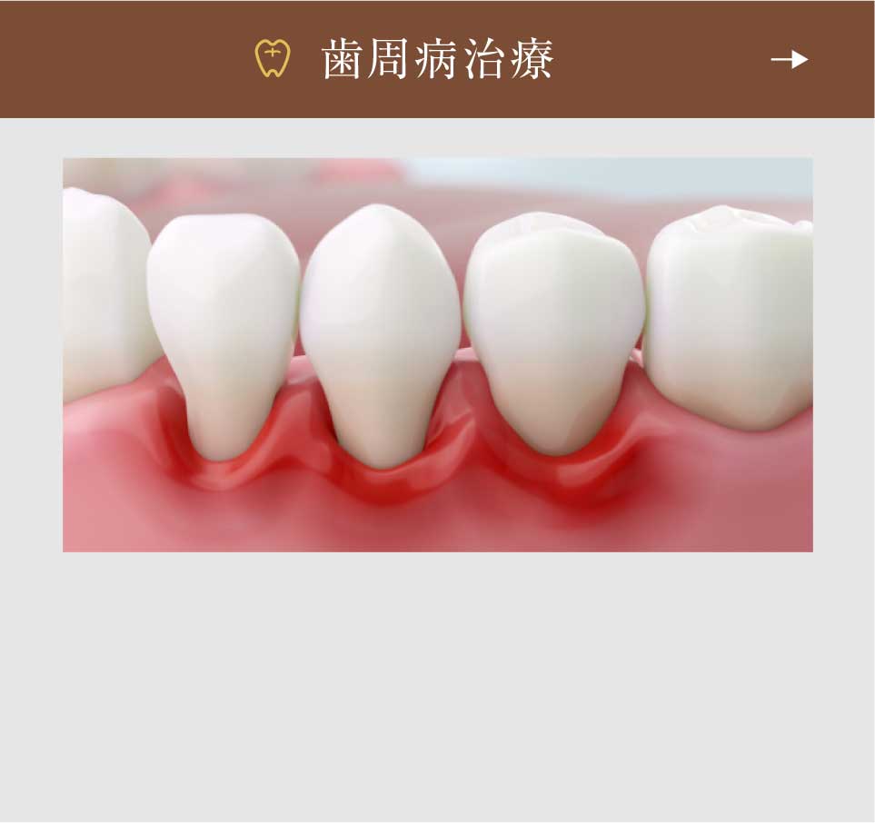 歯周病治療