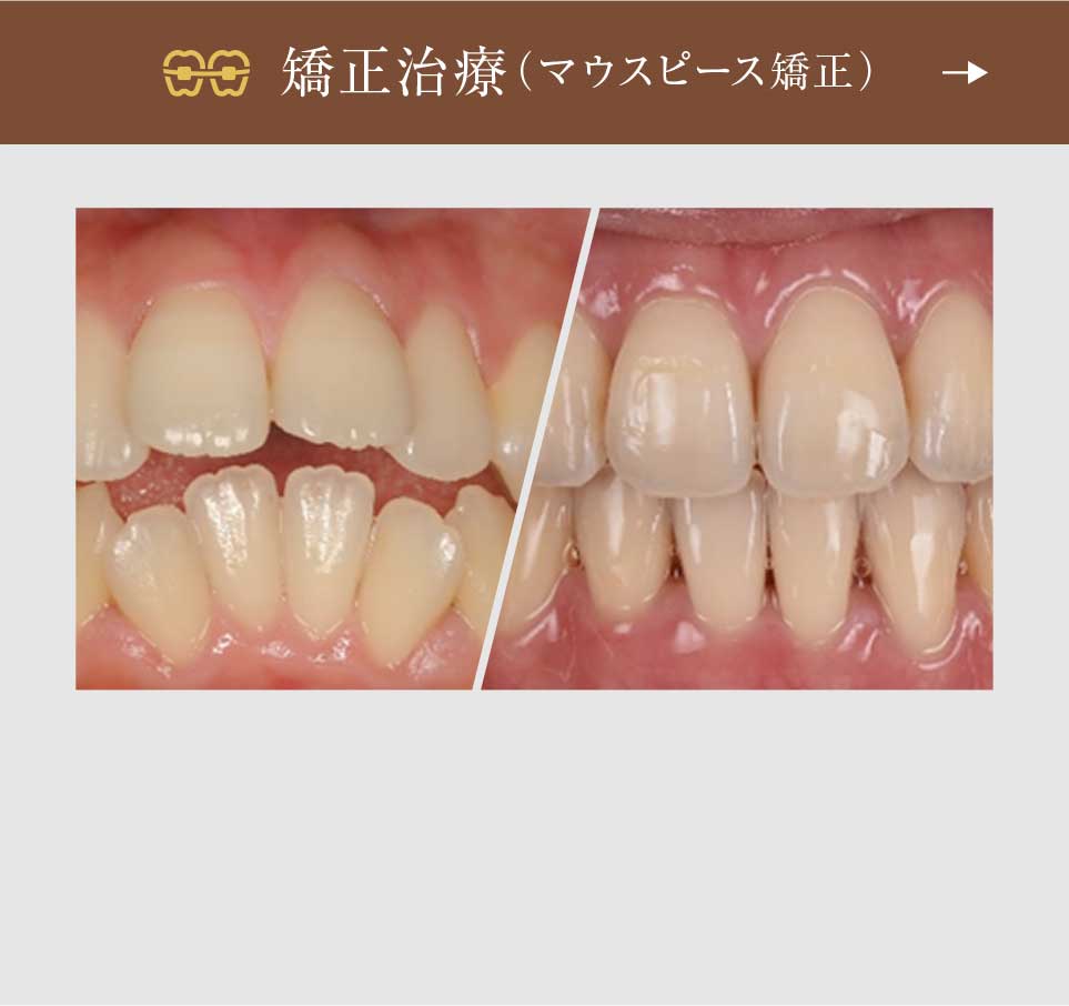 矯正治療（マウスピース矯正）
