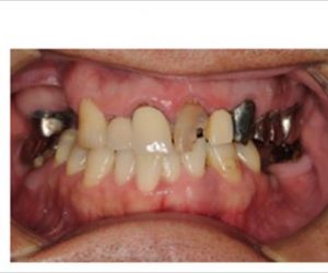 下の前歯の再生療法を行い10年問題ない症例