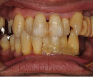 重度歯周病に矯正治療を行い歯を保存した症例