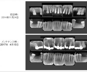 前歯の再生療法と精密根管治療で歯を保存した症例
