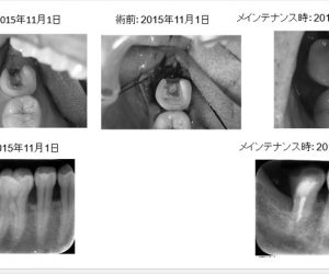 親知らずが食い込み、他院で「抜歯宣告」を受けた症例