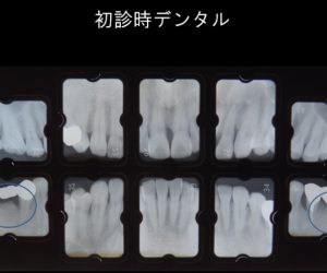 再生療法とインプラントにより歯を保存した症例