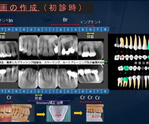 他院で抜歯と言われた歯を保存した症例