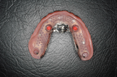 インプラントを使った入れ歯なら「BiVi歯科クリニック」