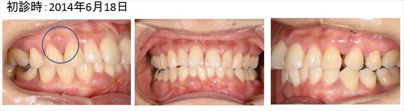 １本の歯も抜かず保存出来ている症例