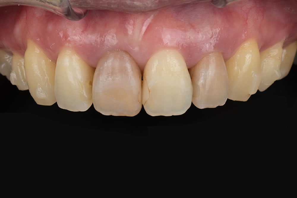 歯茎がしみる方へ実施した根面被覆術の症例