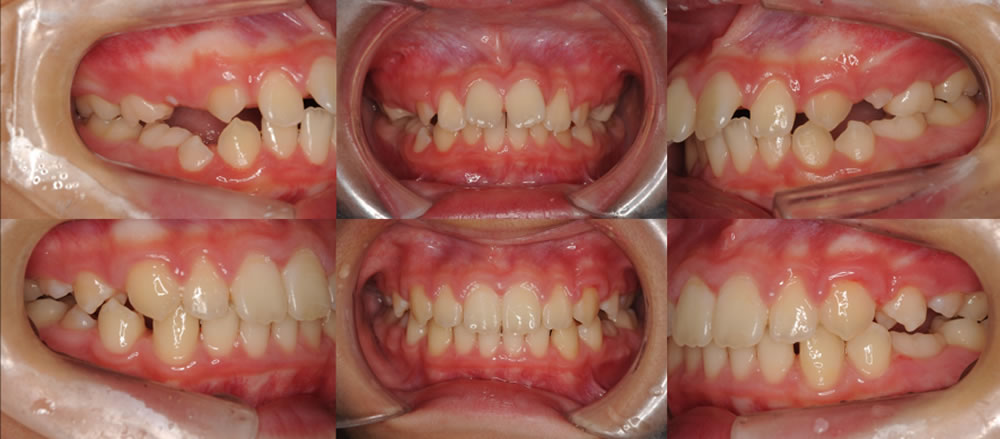 コンビネーション小児矯正治療法