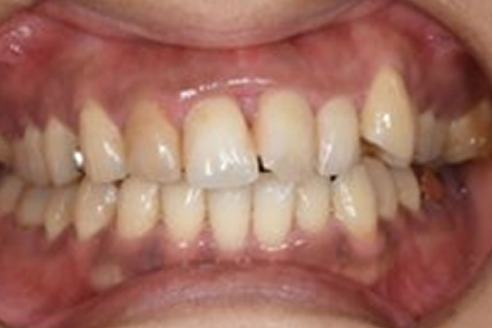 前歯の歯周病を手術しないで治した症例