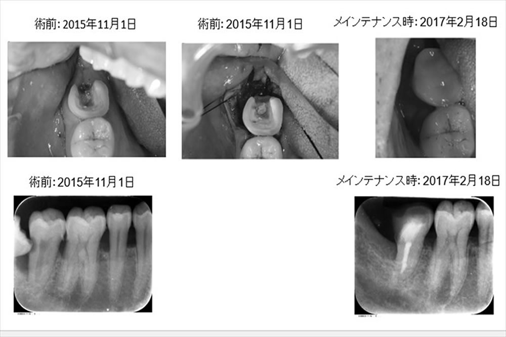 親知らずが食い込み、他院で「抜歯宣告」を受けた症例