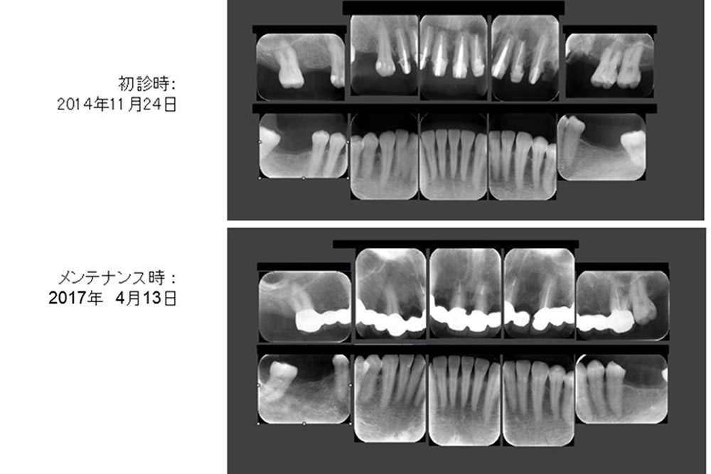 前歯の再生療法と精密根管治療で歯を保存した症例