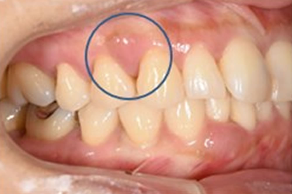 １本の歯も抜かず保存出来ている症例