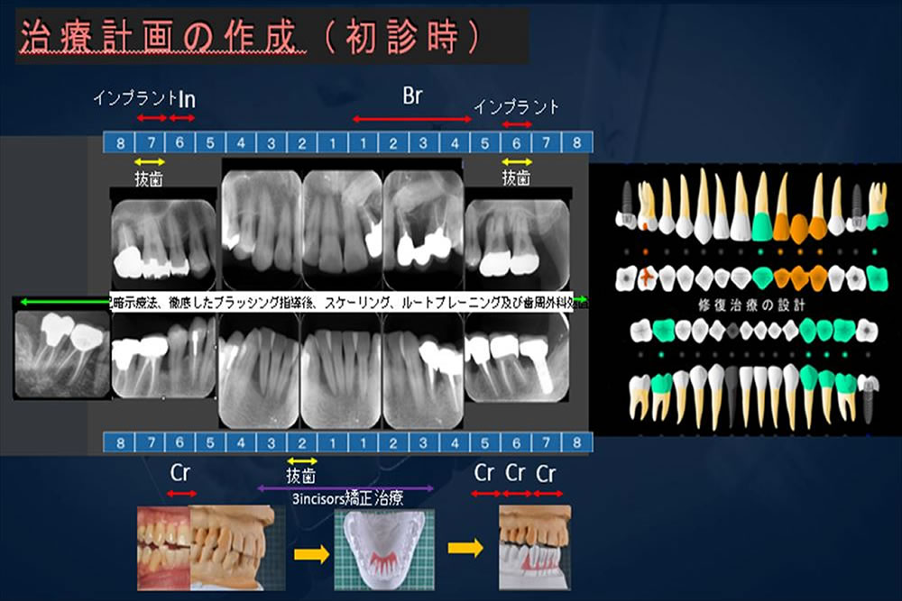 他院で抜歯と言われた歯を保存した症例