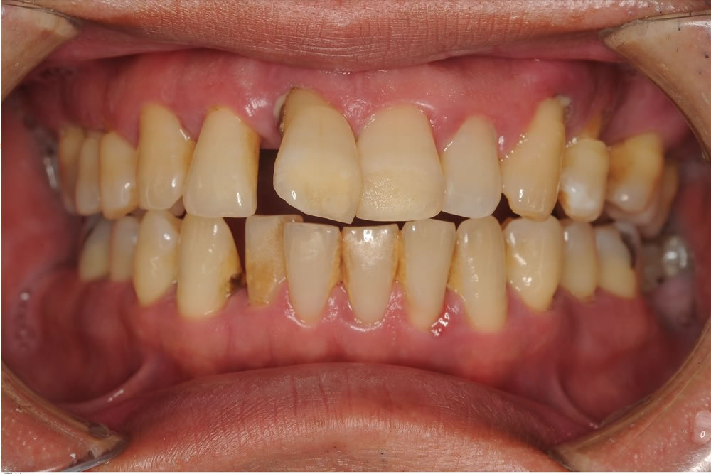 重度歯周病に矯正治療を行い歯を保存した症例