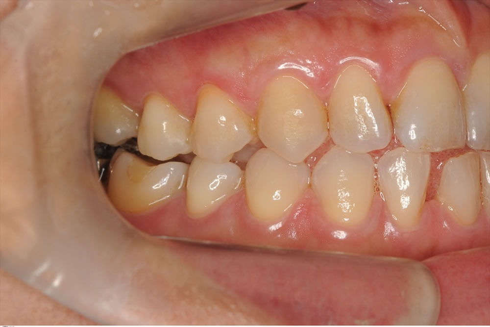 下の前歯の再生療法を行い10年問題ない症例