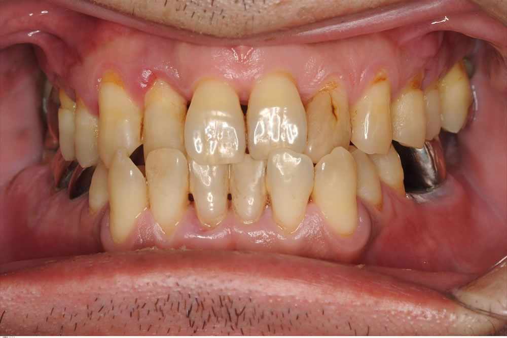 外科処置をせず重度歯周病が改善できている症例