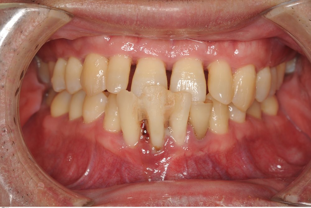 重症の歯周病（stage4)の歯周病を低侵襲で治療した症例