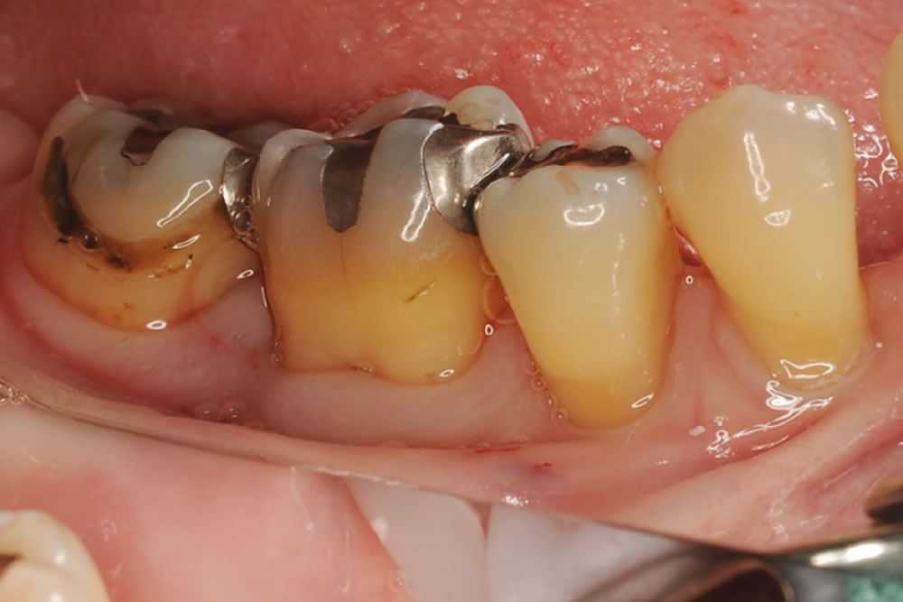 前歯の再生療法と精密根管治療で歯を保存した症例