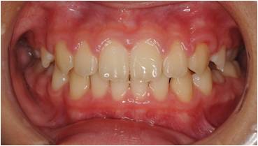 出っ歯の矯正治療後