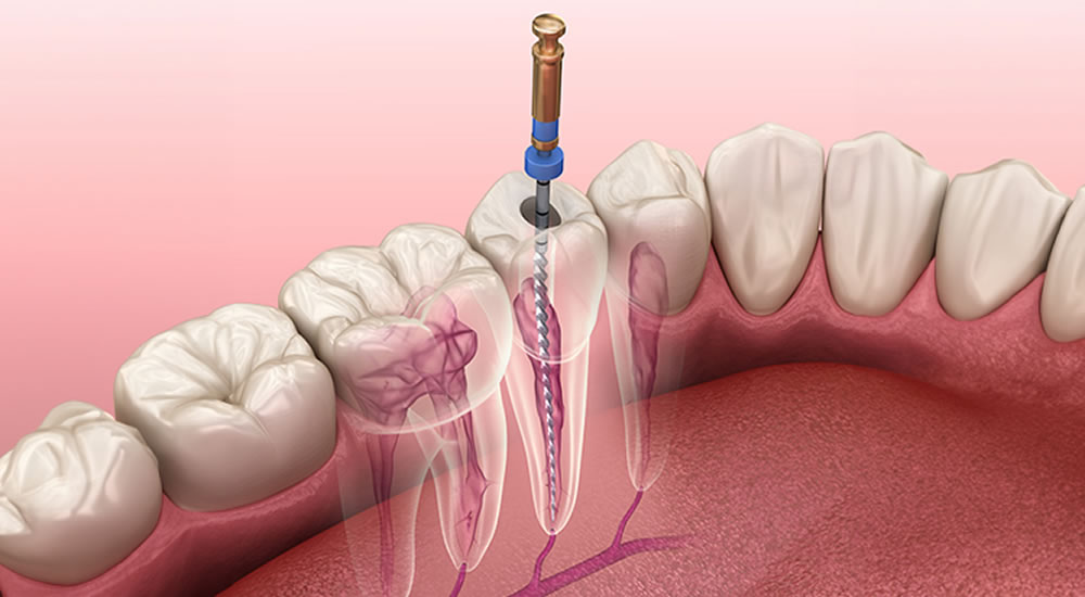 国内有数の根管治療の「専門医」による精密・根管治療