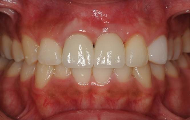 前歯のインプラント治療後