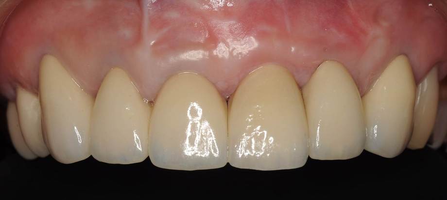 前歯のインプラント治療後
