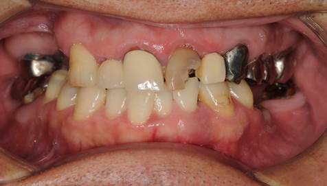 奥歯のインプラント治療前