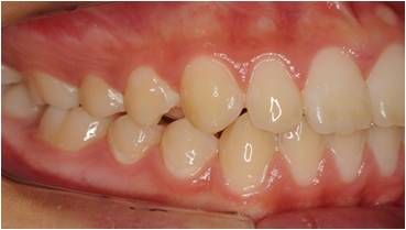 開咬の小児矯正治療後