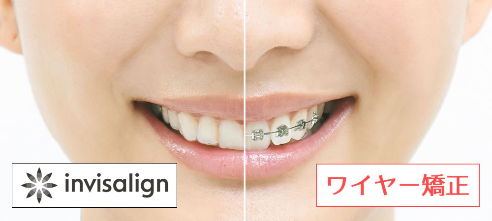 次世代型マウスピース矯正