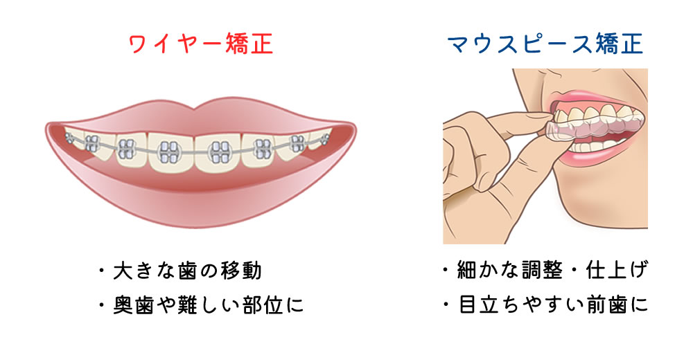 ハイブリッド矯正