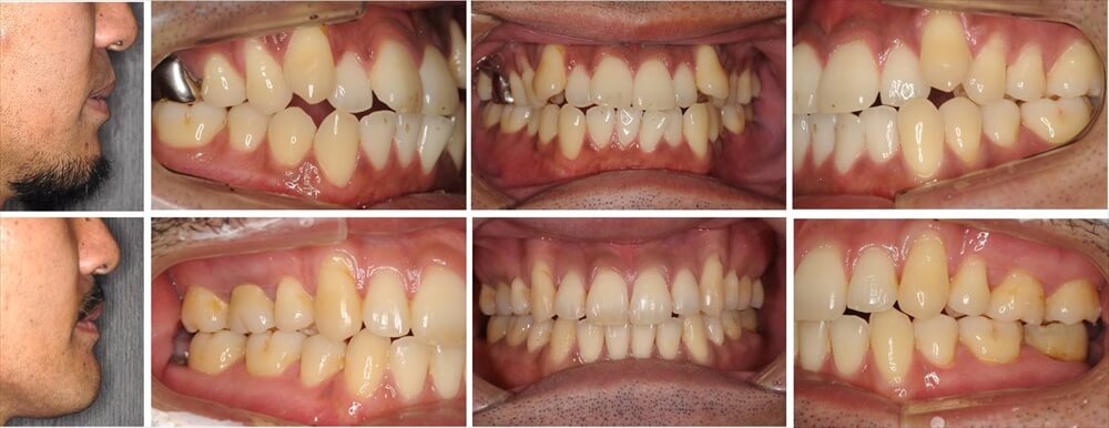 叢生(デコボコ歯列)の大人の矯正治療例