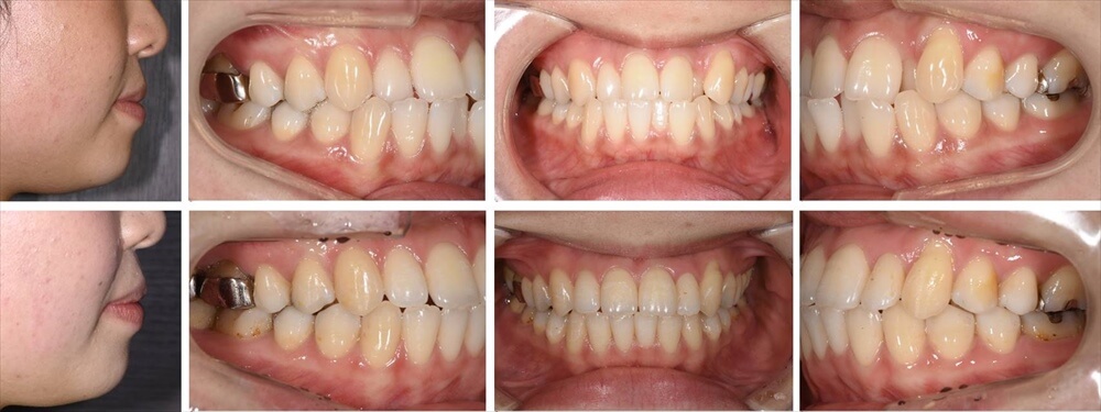 歯科 矯正 ビフォー アフター