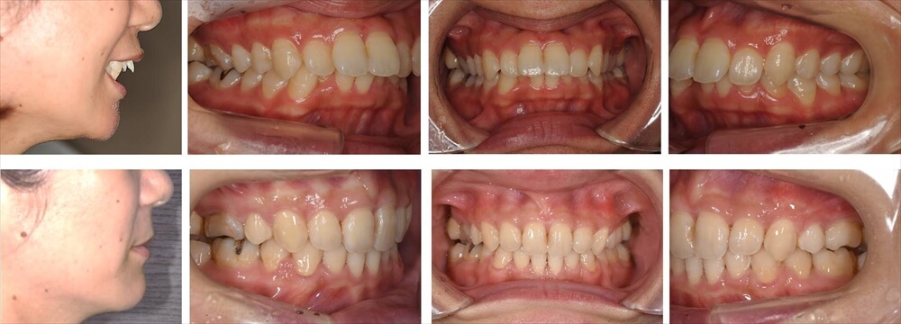 上顎前突(出っ歯)の大人の矯正治療例