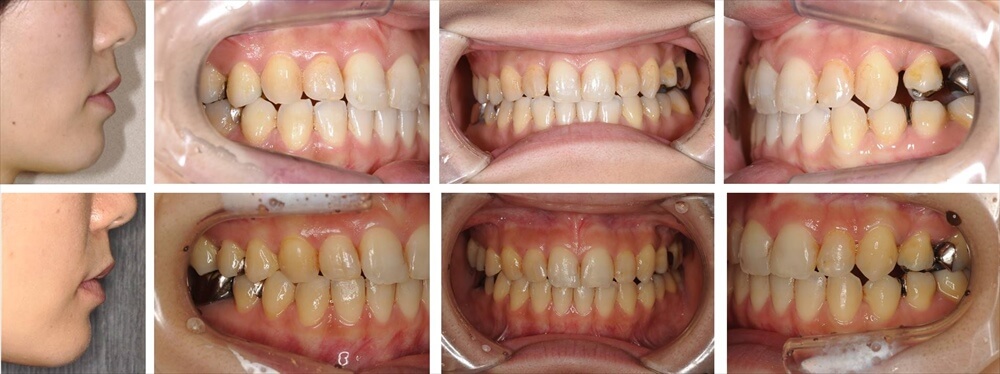 部分矯正の大人の矯正治療例1
