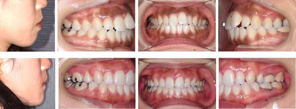 叢生(デコボコ歯列)の大人の矯正治療例3