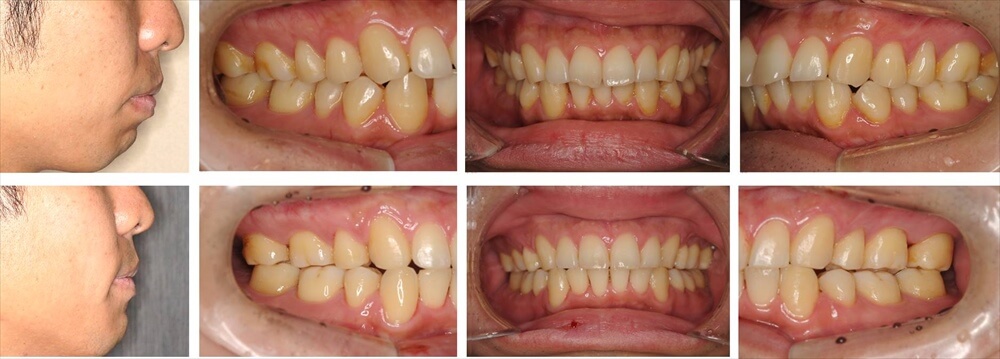 上下顎前突(出っ歯)の大人の矯正治療例1