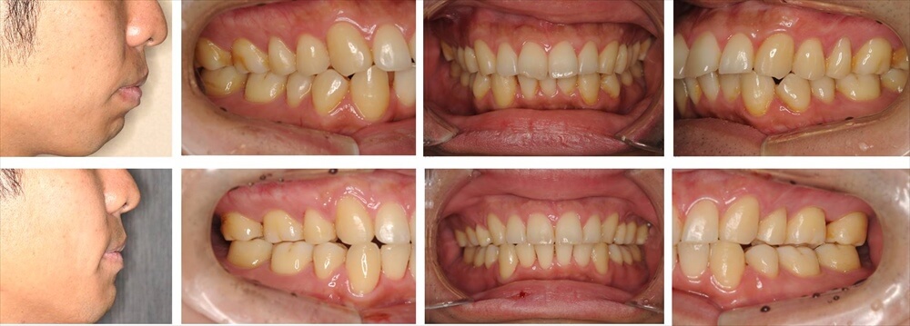 上下顎前突(出っ歯)の大人の矯正治療例