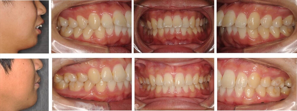 上下顎前突(出っ歯)の大人の矯正治療例