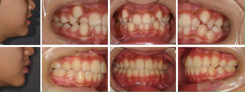 開咬歯列の大人の矯正治療例