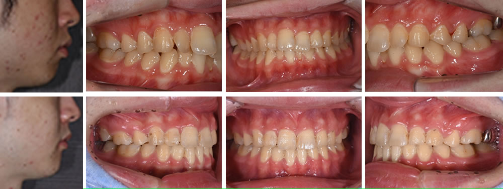 開咬歯列の大人の矯正治療例