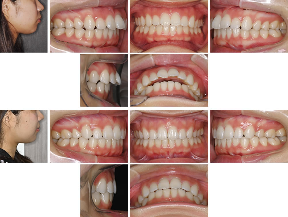 上顎前突(出っ歯)の大人の矯正治療例