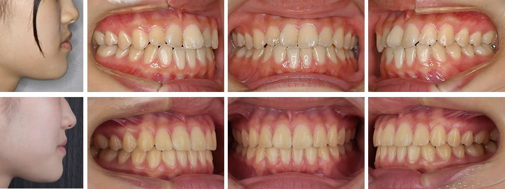 下顎前突(反対咬合)の大人の矯正治療例