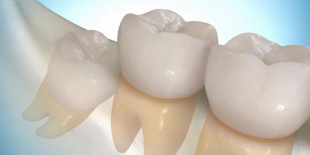 痛くない親知らずの抜歯