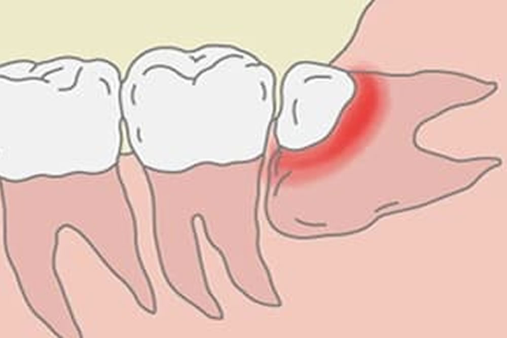 親知らずが歯茎から少し露出している
