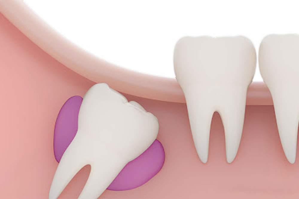 親知らずの周辺に膿の塊がある