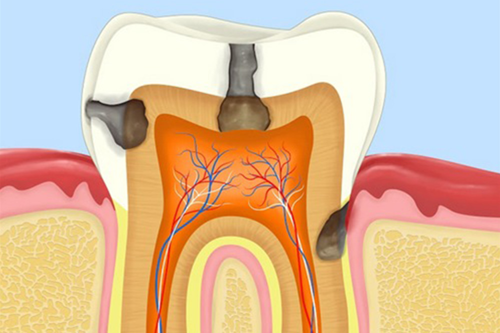 親知らずが重度の虫歯になっている
