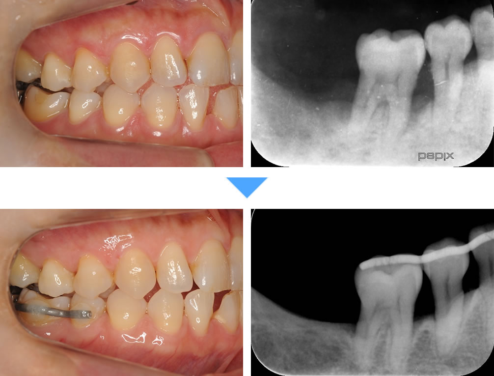 重度歯周病治療【MINST】の症例