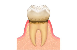 歯肉炎の歯周病治療費