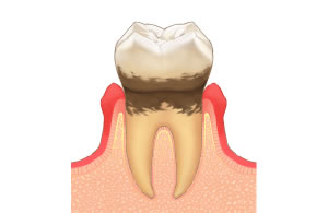 軽度の歯周病治療費